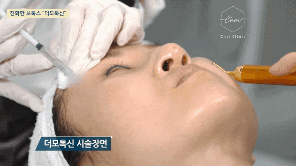 합정 사각턱보톡스 주기 및 효과 차이나는 이유! 관련 이미지 5