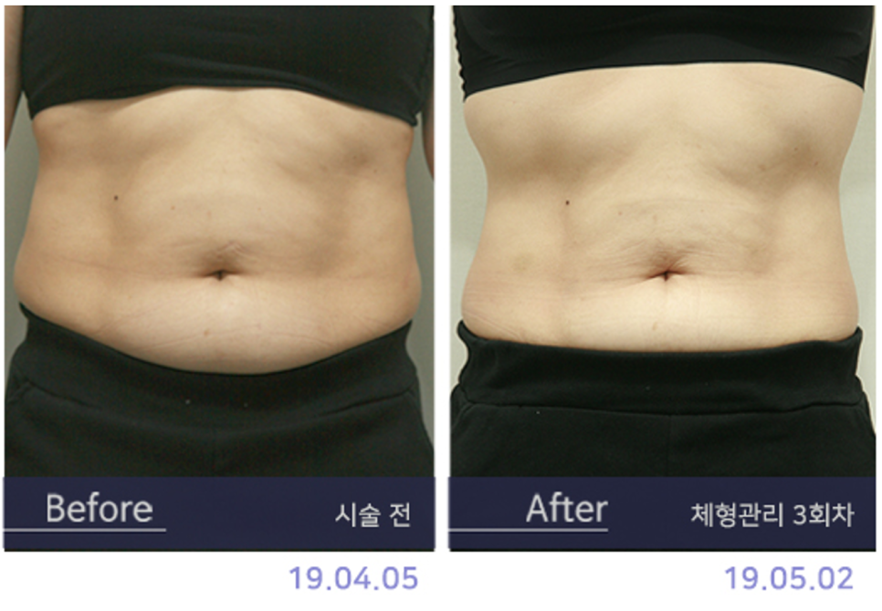 홍대 지방분해주사 복부, 팔뚝, 이중턱 시술 결과는? 관련 이미지 4