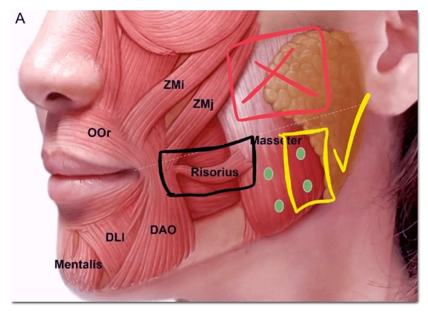 Hongdae Square-Jaw Botox: Should You Get It at a Dental Clinic or Dermatology Clinic? image 6
