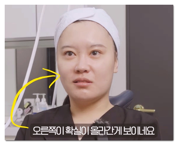 Hapjeong Serf: Who Sees Results and How to Choose a Good Clinic image 4
