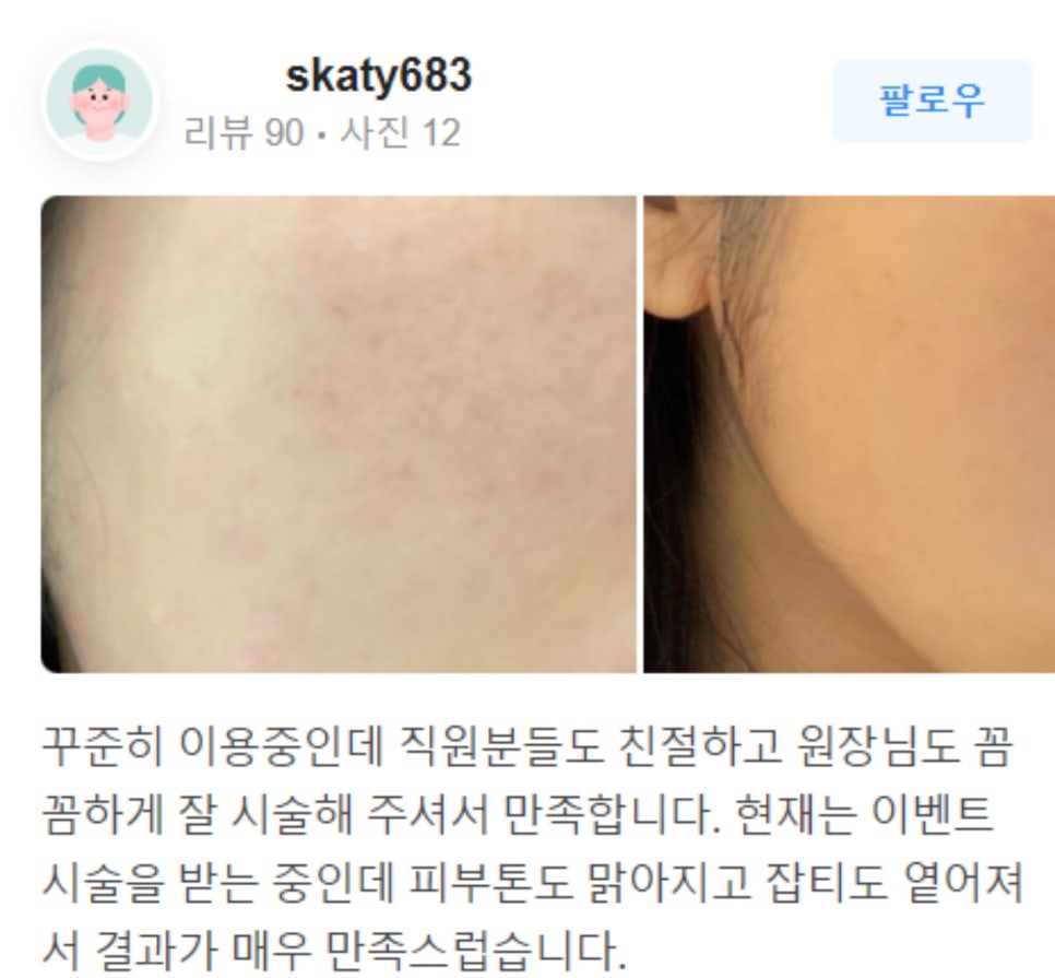 팔자주름 실리프팅 늘어지고 처진 피부를 당겨요! 관련 이미지 15