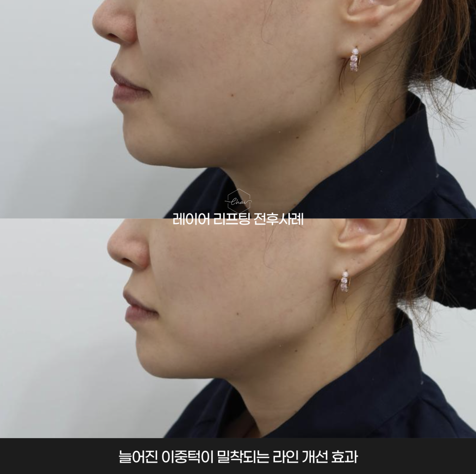 리프팅 부작용의 원인과 개선 방법 관련 이미지 4