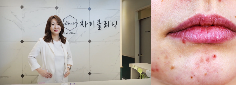 이대역피부관리 지긋지긋한 여드름, 굿바이 하세요 관련 이미지 6