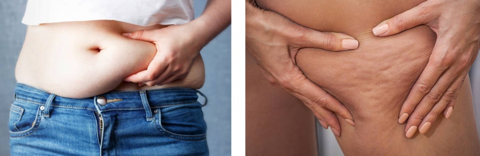 서대문구 피부관리, 늘어진 팔뚝라인 이제 안녕! 관련 이미지 5