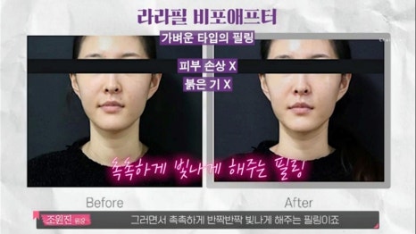 신촌역피부관리 빨리 예뻐져야 할 때 필요한 시술 관련 이미지 4