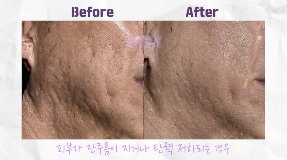 홍대 쥬베룩 볼륨의 개선 효과 관련 이미지 11