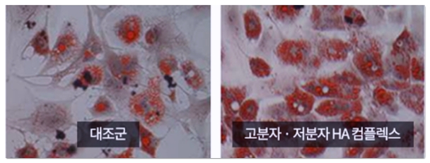 홍대 힐로웨이브 결절 부작용과 쥬베룩 눈밑 팔자에 괜찮을까 관련 이미지 7