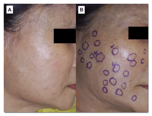 Hongdae Sculptra: The 233 Rule for Treatment Without Worrying About Nodules image 6