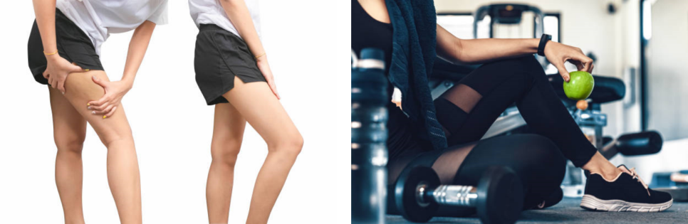종아리보톡스비용 포토샵처럼 다리알 쏙 빼기 관련 이미지 4