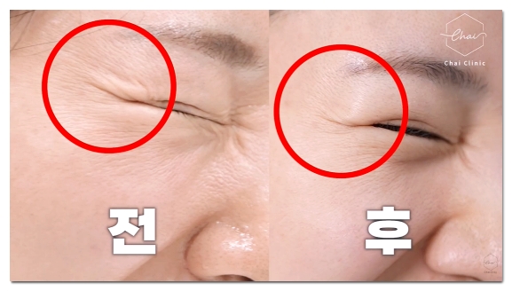 슈링크 효과 언제부터일까? 시기별 효과 및 유지기간 총정리 관련 이미지 3