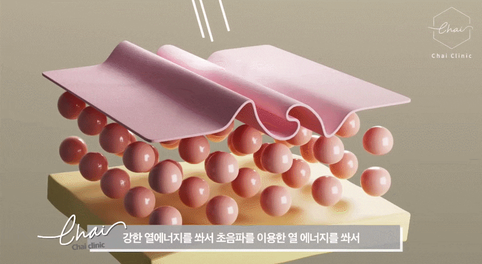 피부탄력 레이저 울써마지, 코레지로 리프팅 업 관련 이미지 4