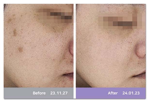 How Does Dual Toning Differ from Regular Laser Toning? image 7