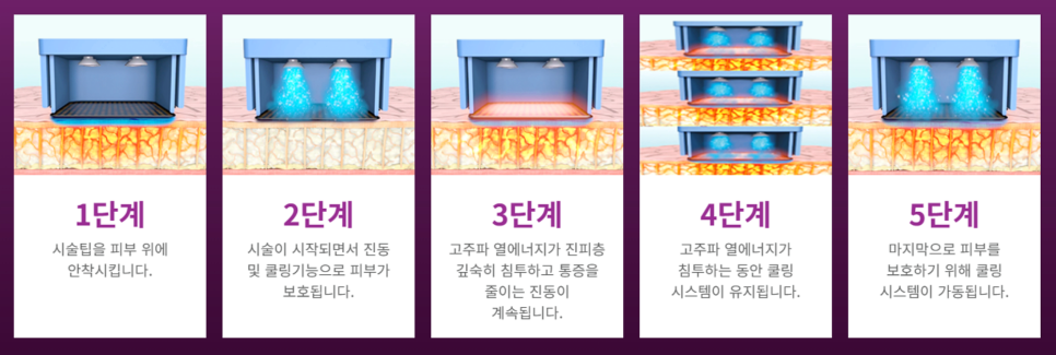 써마지 피부관리 좋은 효과를 원한다면 반드시 확인해야 하는 것 관련 이미지 7
