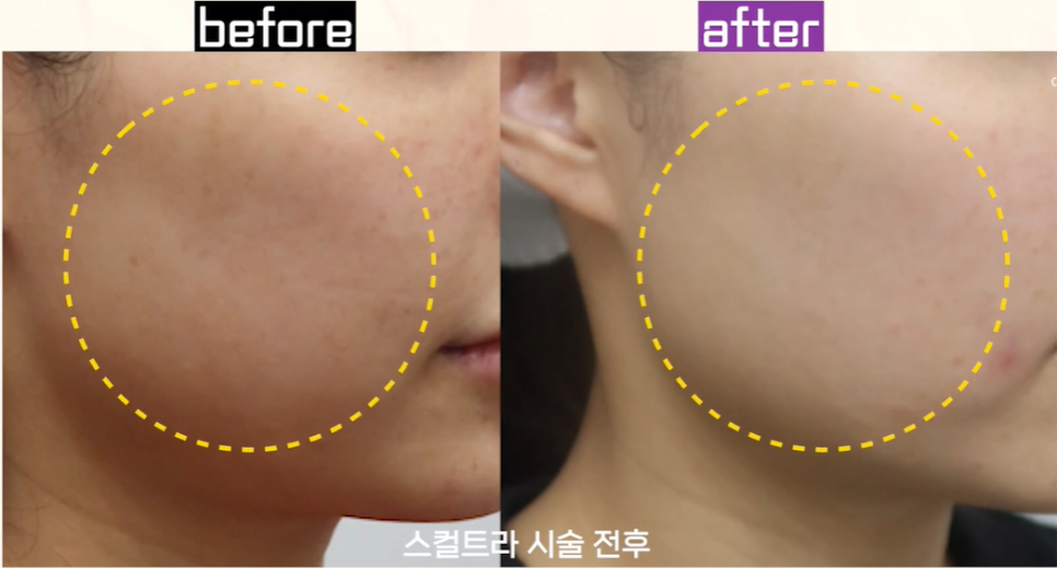 The 233 Rule for Reducing Sculptra Nodule Side Effects in Hongdae image 7