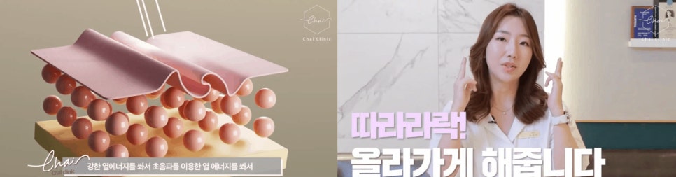 울쎄라슈링크? 축 처지는 피부를 위한 최적의 리프팅 관련 이미지 3