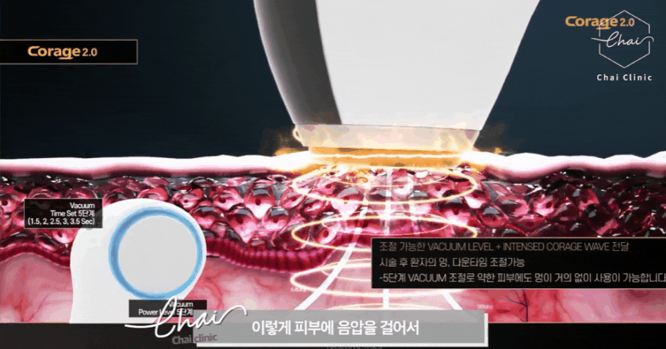 피부관리레이저종류 합정 울써마지까지 한방에 정리! 관련 이미지 5