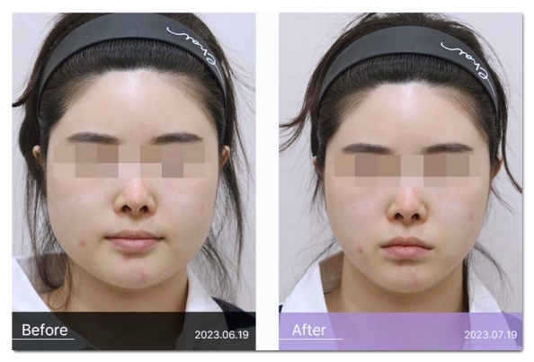 Why Can a Bad Chin Botox Injection Make Your Face Look Bigger in Hongdae? image 7