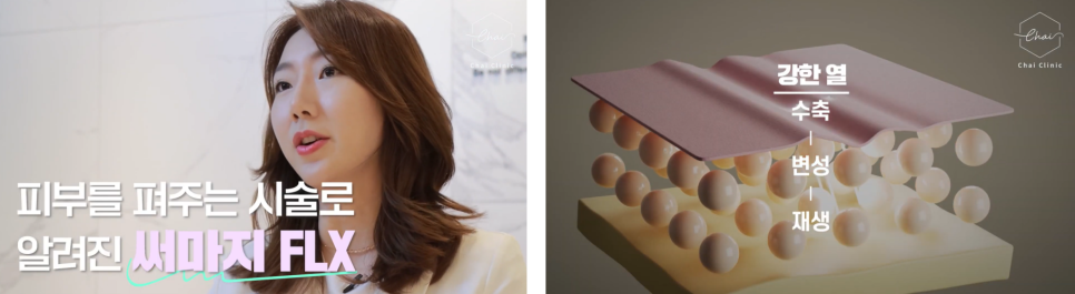 합정 써마지레이저 효과 없는 4가지 이유 관련 이미지 3