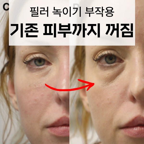 필러 녹이기 부작용 그냥 했다가 두번 후회하는 이유 3가지 관련 이미지 3