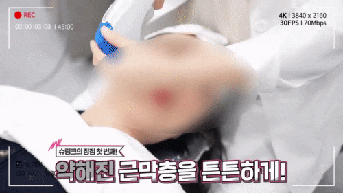 망원 리프팅 종류와 부작용 알고 시작하세요 관련 이미지 7