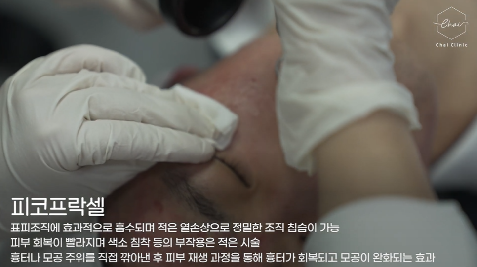 여드름흉터 시술 유형별로 달라야 하는 까닭은? 관련 이미지 4
