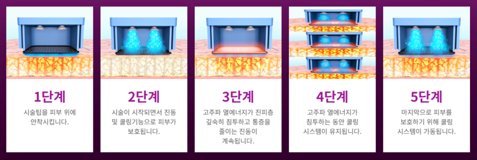 합정 써마지잘하는곳의 차이는 바로 이것! 관련 이미지 4