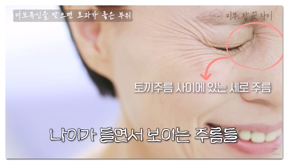 Mapo Botox: 3 Things to Check Before You Regret Getting It Cheap image 2