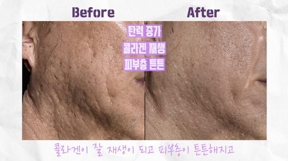 합정피부관리 차이의원의 단계별 체계적인 쥬베룩 흉터 치료 관련 이미지 1