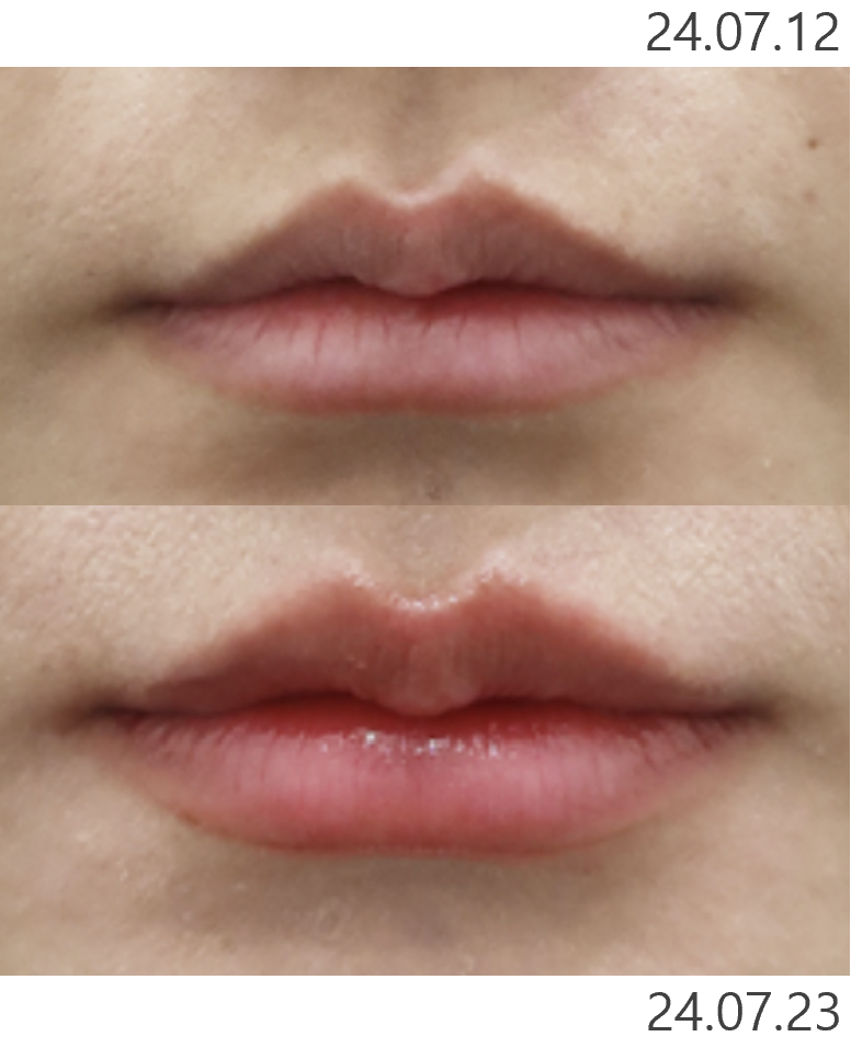 Lip Filler 1cc Before and After: Pain, Duration, and Precautions image 3