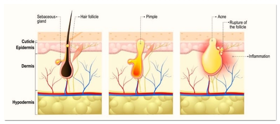 3 Things to Check When You Need an Anti-Inflammatory Acne Injection in Hongdae, Urgently image 6