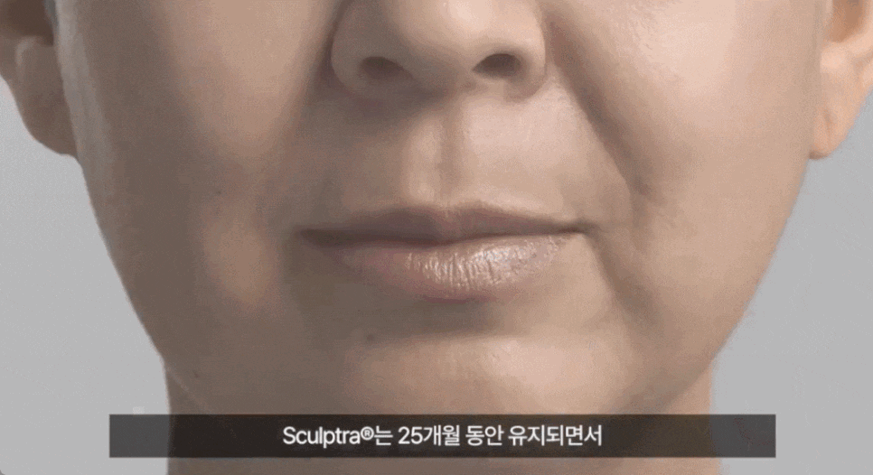 볼꺼짐필러, 자연스럽게 얼굴 볼륨을 높이는 비결 관련 이미지 5