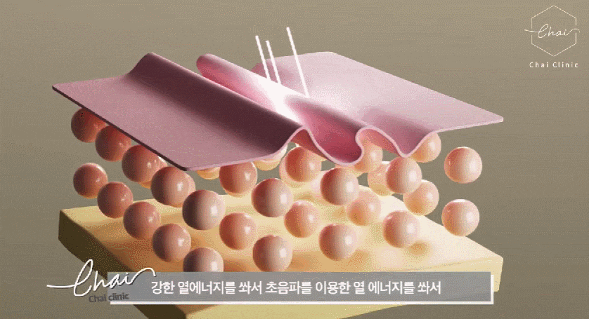 V라인리프팅 후기만 보고 결정하지 마세요! 관련 이미지 3