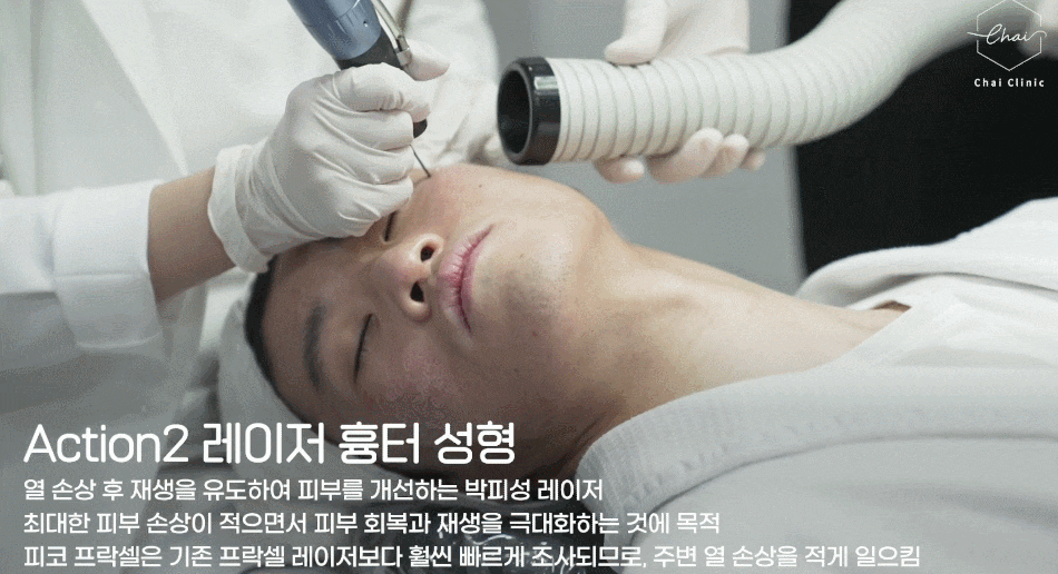 망원동피부관리, 여드름 흉터 지워드립니다 관련 이미지 5