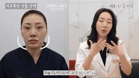 스킨보톡스 주의사항 효과 높이는 후 관리 관련 이미지 3