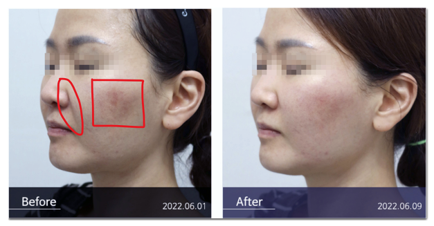 Recommended Treatments for Nasolabial Folds (Ulthera/Thermage/EMFACE/Juvelook Volume/Thread Lifting) image 6