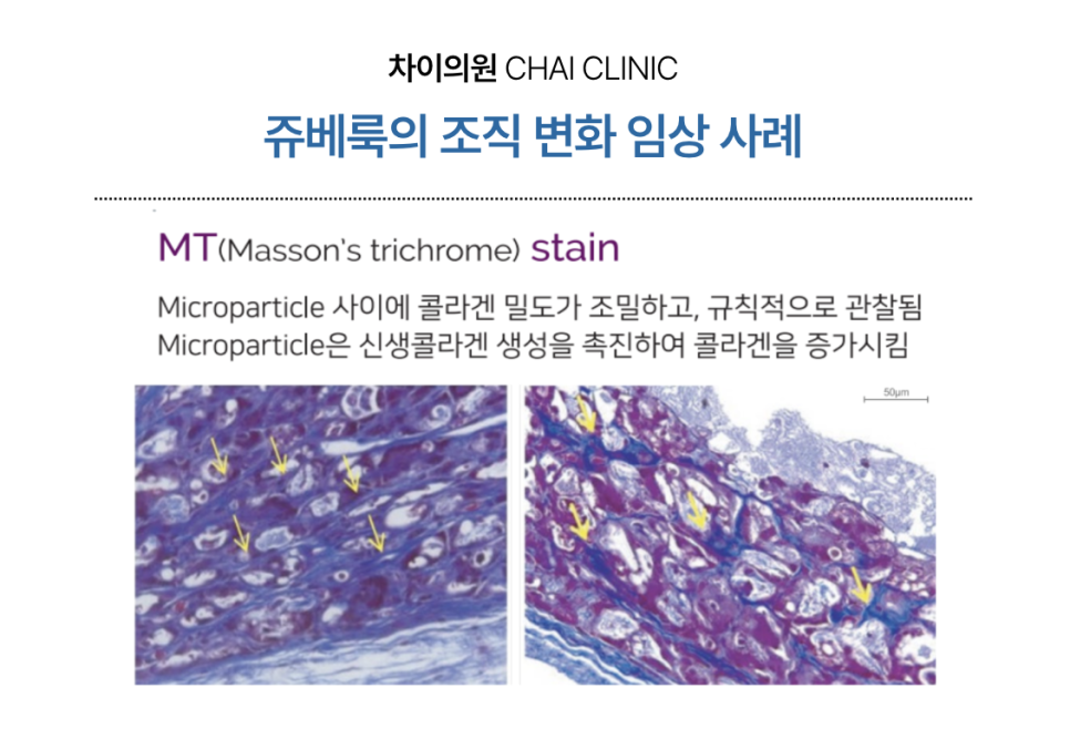 눈밑 쥬베룩 볼륨의 효과와 유지기간 관련 이미지 6