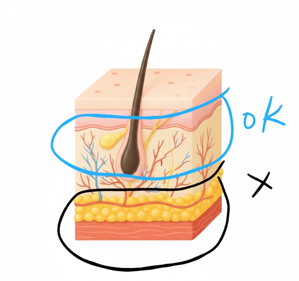 3 Things to Check When You Need an Anti-Inflammatory Acne Injection in Hongdae, Urgently image 4