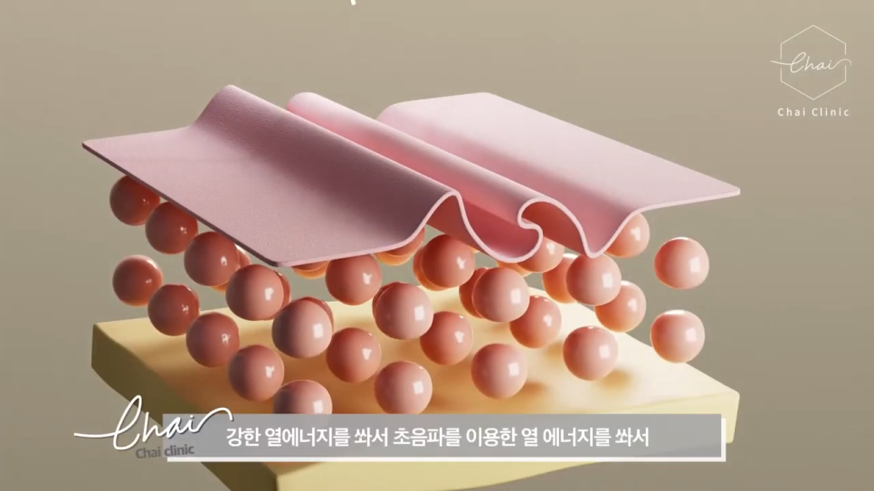 당산 피부관리, 울쎄라 부작용인 볼패임을 줄이려면 관련 이미지 3
