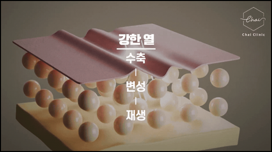 울쎄라 써마지 차이 무엇이 다를까? 관련 이미지 4