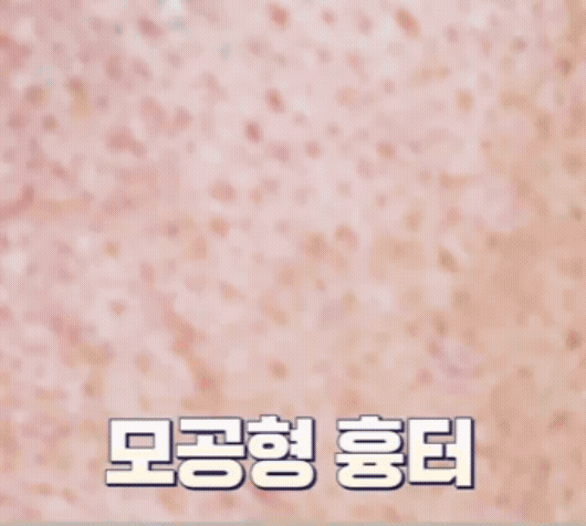 홍대 포텐자 모공 제대로 조이려면 이 2가지는 꼭 보세요 관련 이미지 10