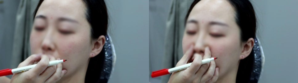미간주름필러 하기 전 반드시 확인해야 할 것은 관련 이미지 6