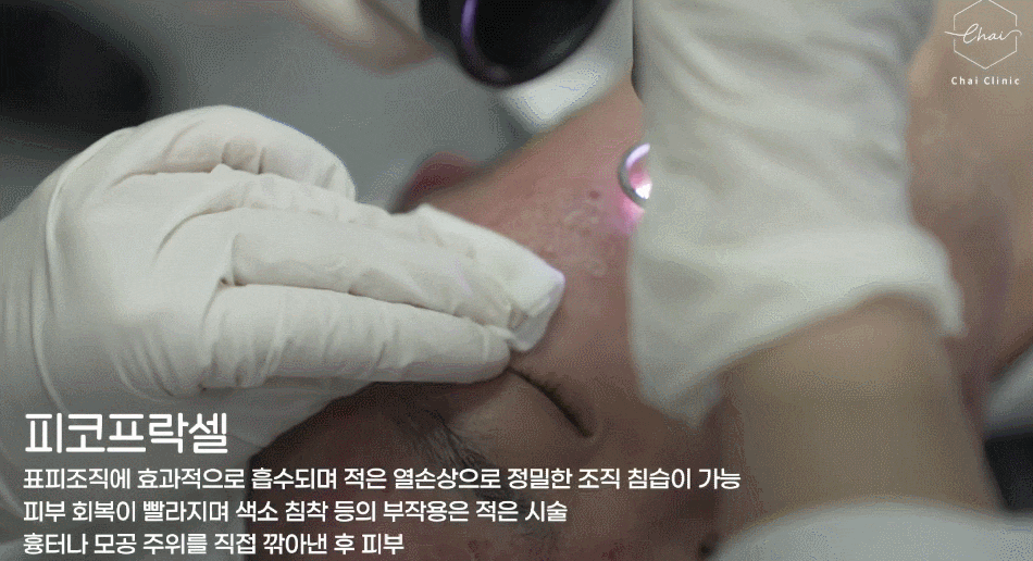 망원동피부관리, 여드름 흉터 지워드립니다 관련 이미지 6