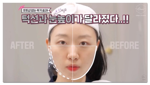 합정 슈링크 효과 보려면 어떻게 받아야 할까? (잘하는 곳 기준) 관련 이미지 6