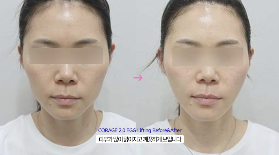 슈링크 유니버스 효과를 높이는 레이어 리프팅 관련 이미지 18