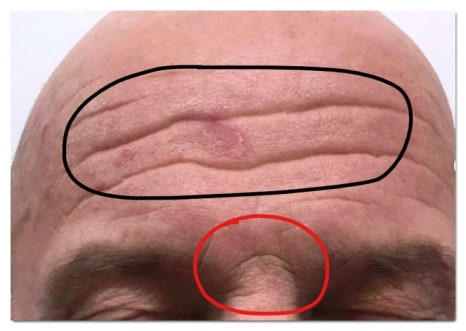 마포역 보톡스 맞기 전 몰라서 후회하는 3가지 관련 이미지 4