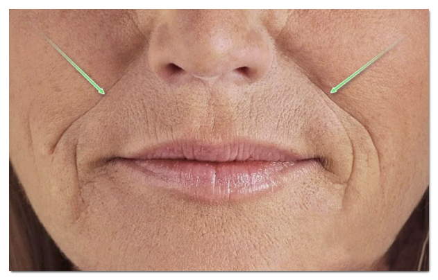 Recommended Treatments for Nasolabial Folds (Ulthera/Thermage/EMFACE/Juvelook Volume/Thread Lifting) image 3