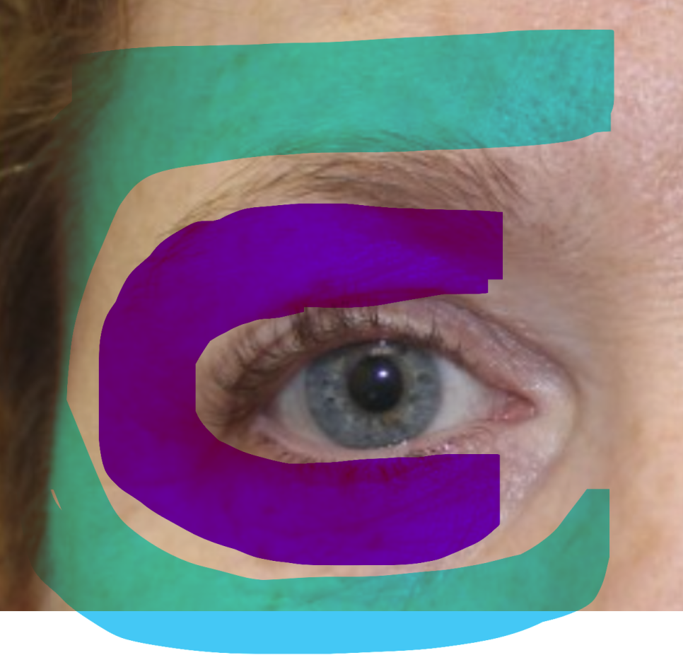 Differences and Effect Comparison Between Eye Thermage and Eye Ultherapy image 5