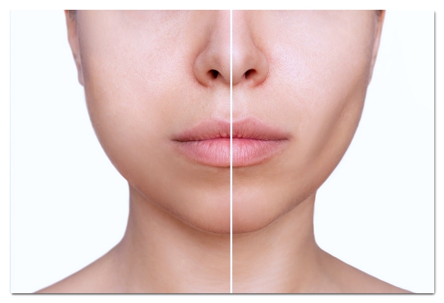 3 Cases Where You’ll Regret Masseter Botox in Hongdae image 3