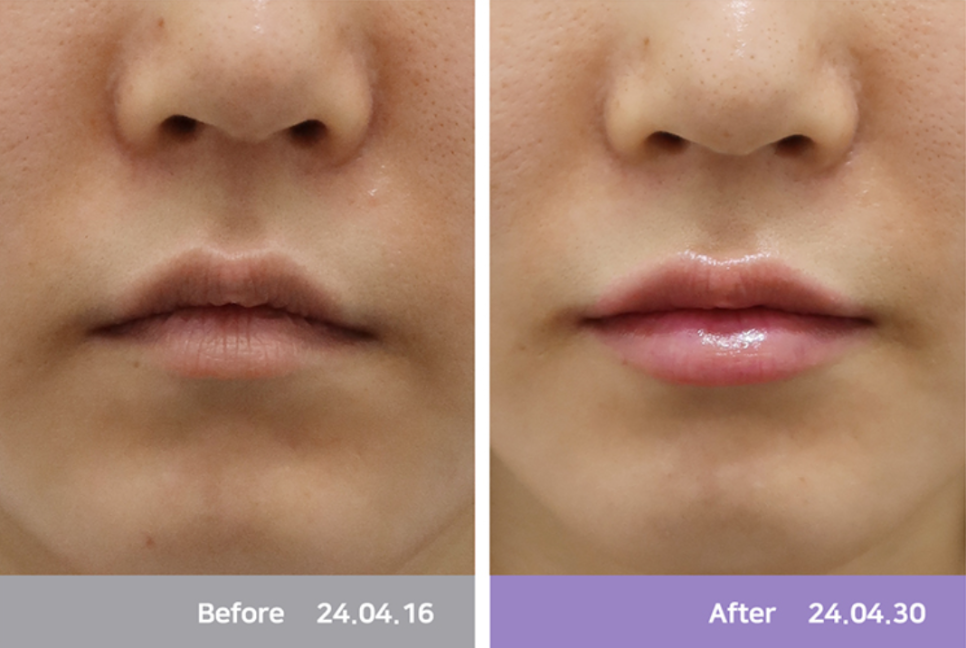 3 Characteristics of a Good Place for Lip Fillers in Hapjeong image 3