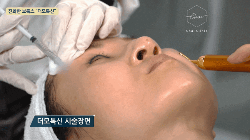 팔자주름보톡스 후기만 믿고 결정하면 안되는 이유 관련 이미지 7